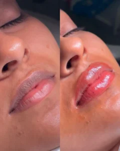 Is It Safe to Kiss After Lip Neutralisation