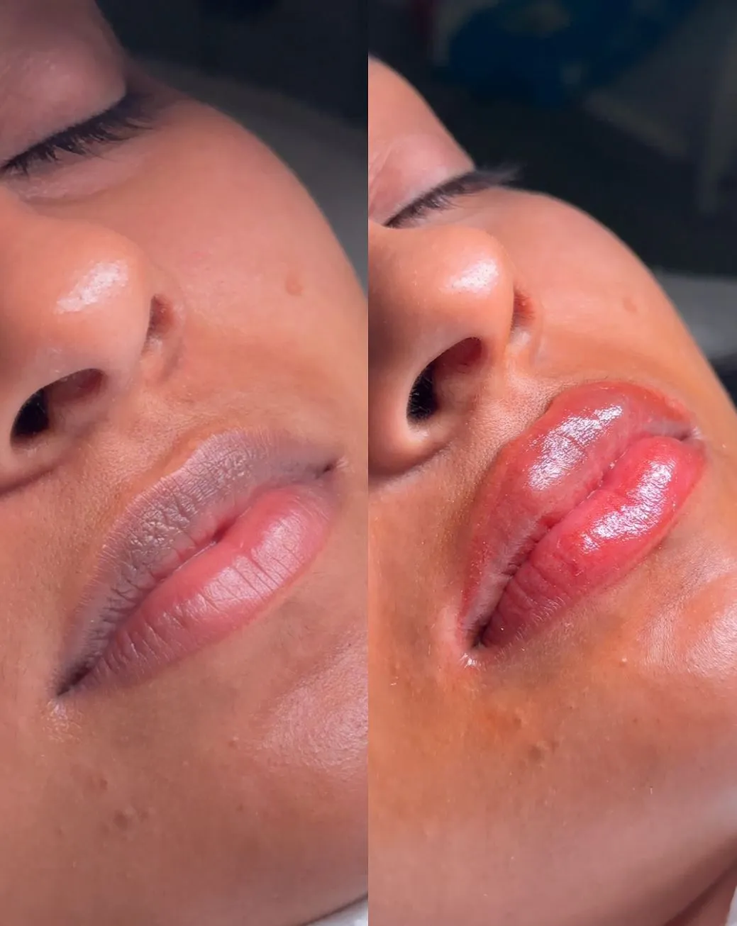 Is It Safe to Kiss After Lip Neutralisation