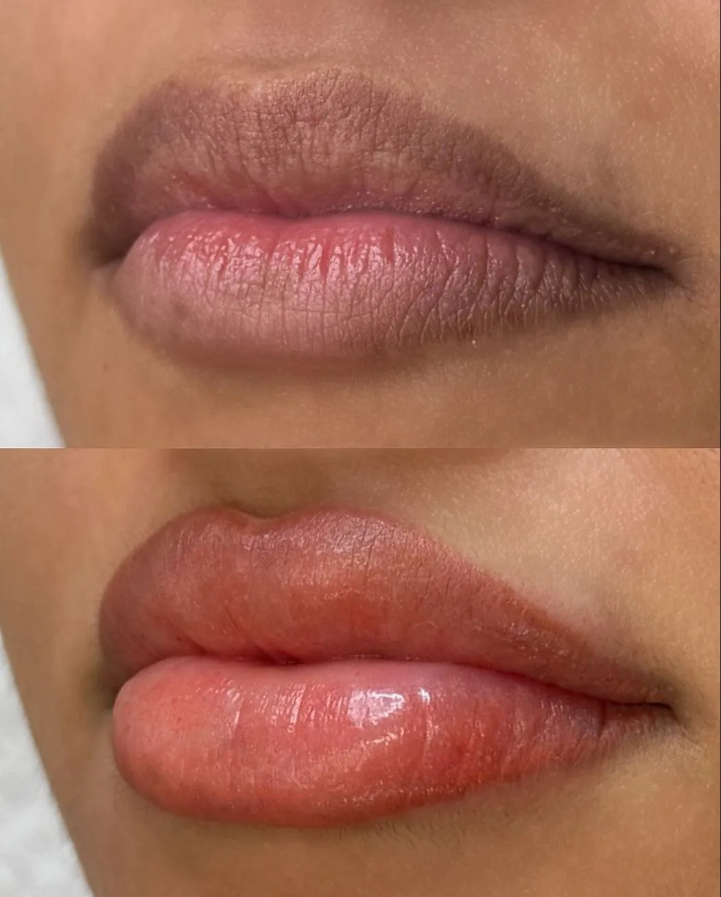 Who’s a Good Candidate for Lip Neutralising