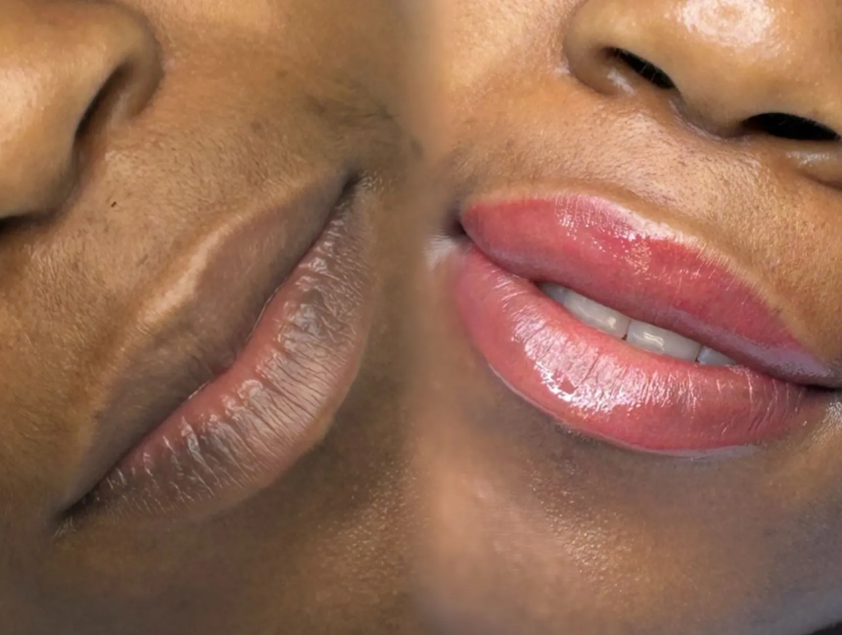 cosmetic tattoo treatment